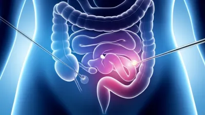 Illustration laparoscopy