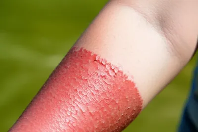 Illustration sunburned - Image 1