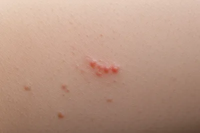 Illustration papules - Image 1