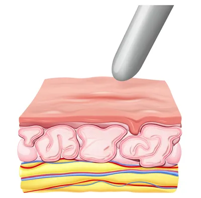 Illustration skin - Image 1