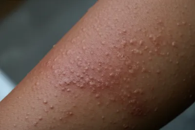 Illustration eruption - Image 1