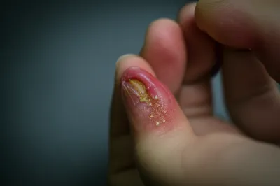 Illustration festered - Image 1