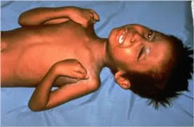 Illustration tetanus - Image 2