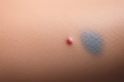 Illustration nevus - Image 1