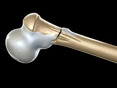 Illustration calluses - Image 1