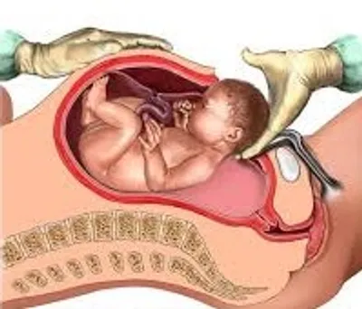 Illustration cesarean - Image 2