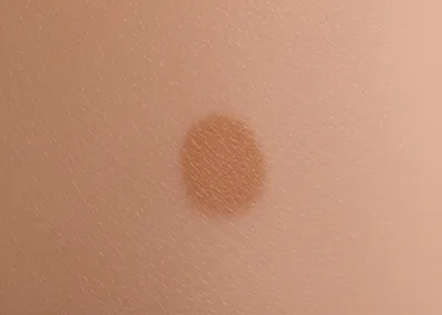 Illustration lentigo - Image 1