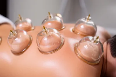 Illustration cupping - Image 1