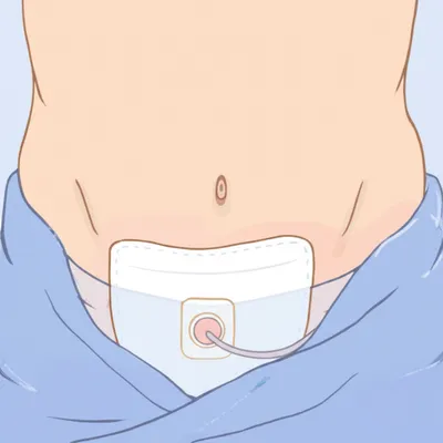 Illustration stoma - Image 1