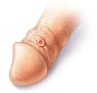 Illustration syphilis - Image 2