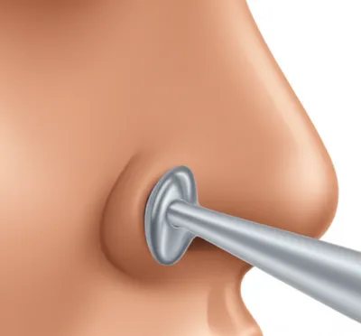Illustration dilator - Image 1