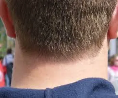 Illustration nape - Image 2