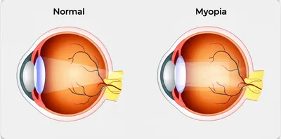 Illustration dioptres - Image 1