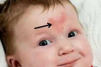 Illustration congenital - Image 2