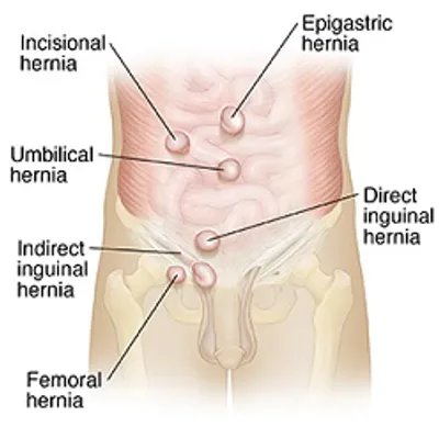Illustration hernia - Image 2