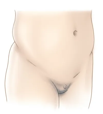 Illustration inguinal