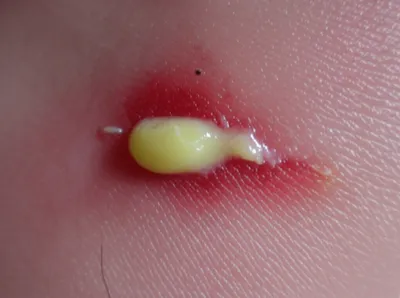 Illustration suppurate