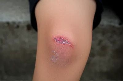 Illustration abrasion - Image 1