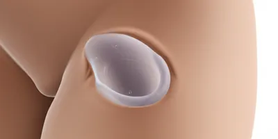 Illustration pessary - Image 1