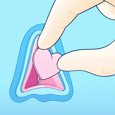 Illustration implantations - Image 1