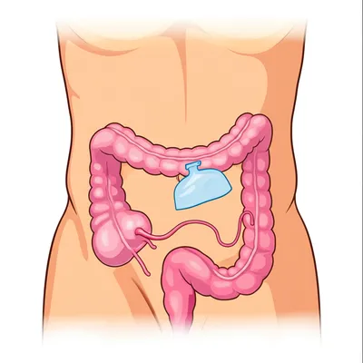 Illustration ileostomy