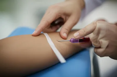 Illustration venesection