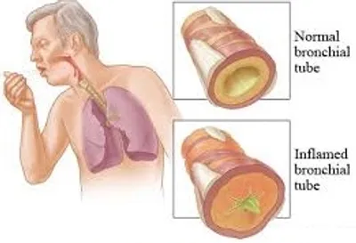Illustration bronchitis - Image 2