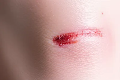 Illustration scab - Image 1