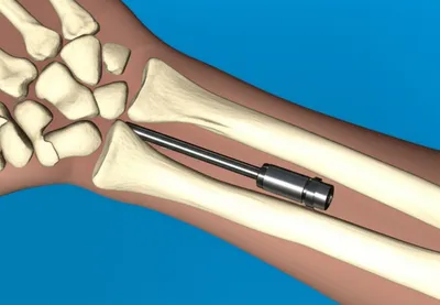 Illustration wrist - Image 1