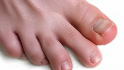 Illustration bunions - Image 1