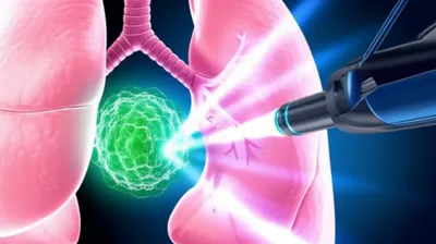 Illustration ablation - Image 1