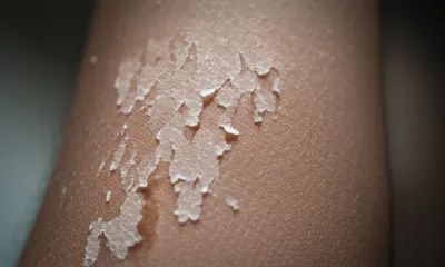 Illustration scurf - Image 1