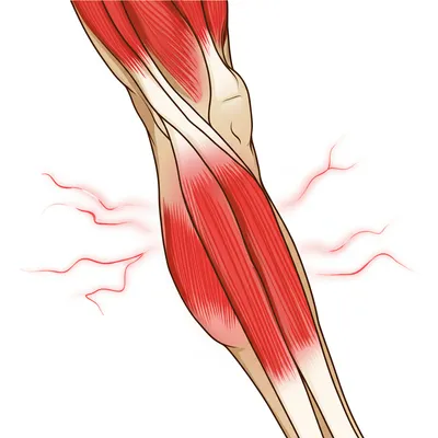 Illustration cramp - Image 1