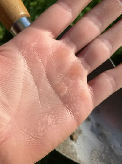 Illustration callosity - Image 1