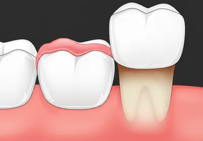 Illustration operculum - Image 1