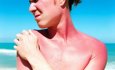 Illustration burns - Image 1