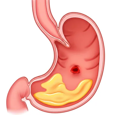 Illustration ulcer - Image 1