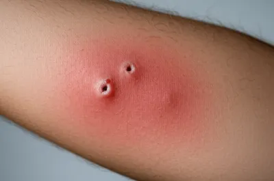 Illustration snakebites