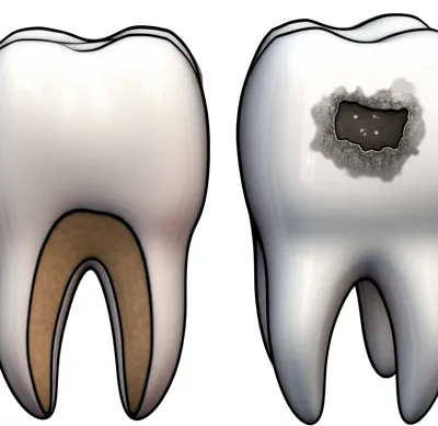 Illustration cavity - Image 1