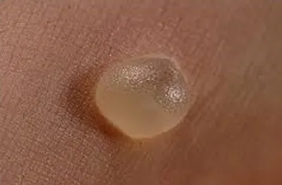 Illustration blister - Image 2