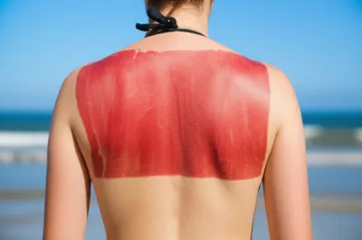 Illustration burned - Image 1