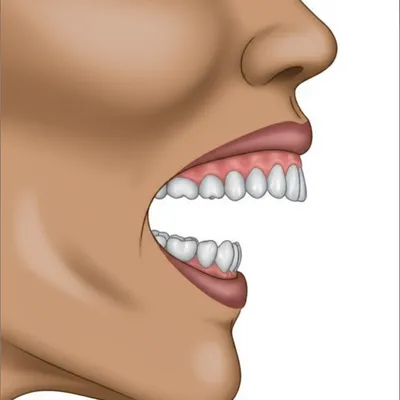 Illustration overbite - Image 1