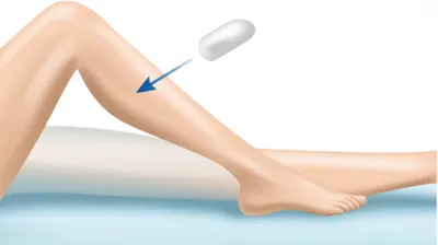 Illustration pessary - Image 1