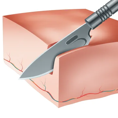 Illustration incision