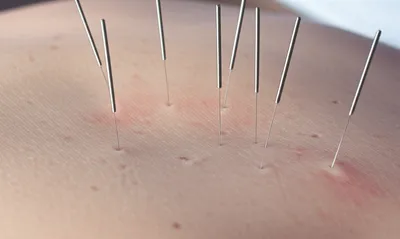 Illustration acupuncture