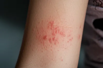 Illustration scab - Image 1