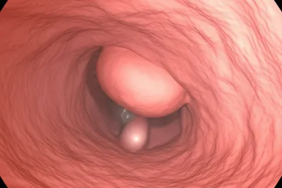 Illustration polyp - Image 1