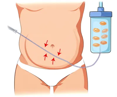 Illustration liposuction