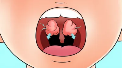 Illustration adenoids