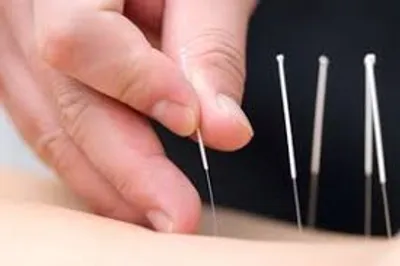 Illustration acupuncture - Image 2